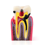 6 Times Dental Caries Anatomy Comparison Model Teaching Learning Tools - pairaydental.com