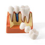 Dental 4 Times Teeth Model Implant Analysis Crown Bridge Demonstration Removable Model - pairaydental.com