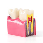 6 Times Dental Caries Anatomy Comparison Model Teaching Learning Tools - pairaydental.com