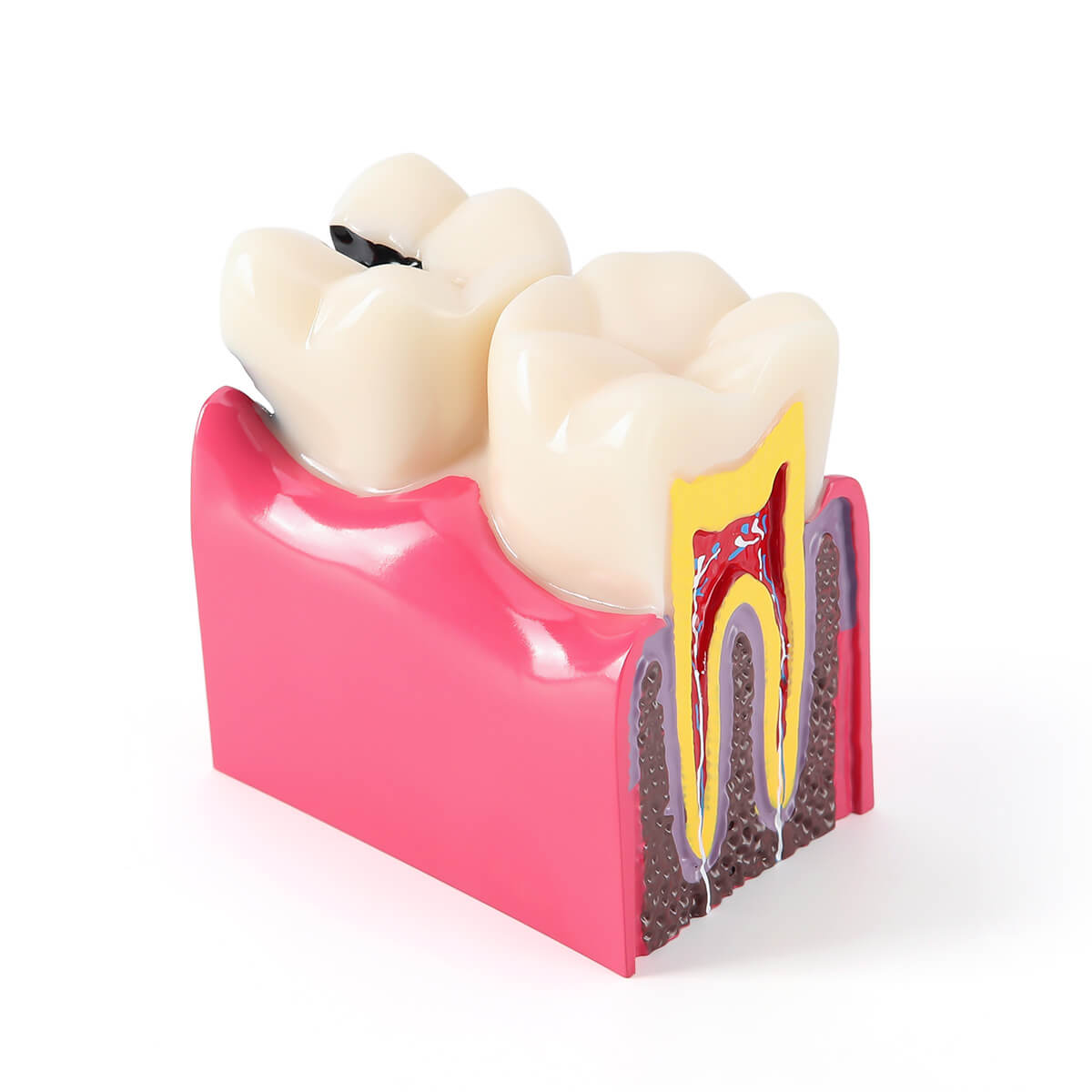 6 Times Dental Caries Anatomy Comparison Model Teaching Learning Tools - pairaydental.com