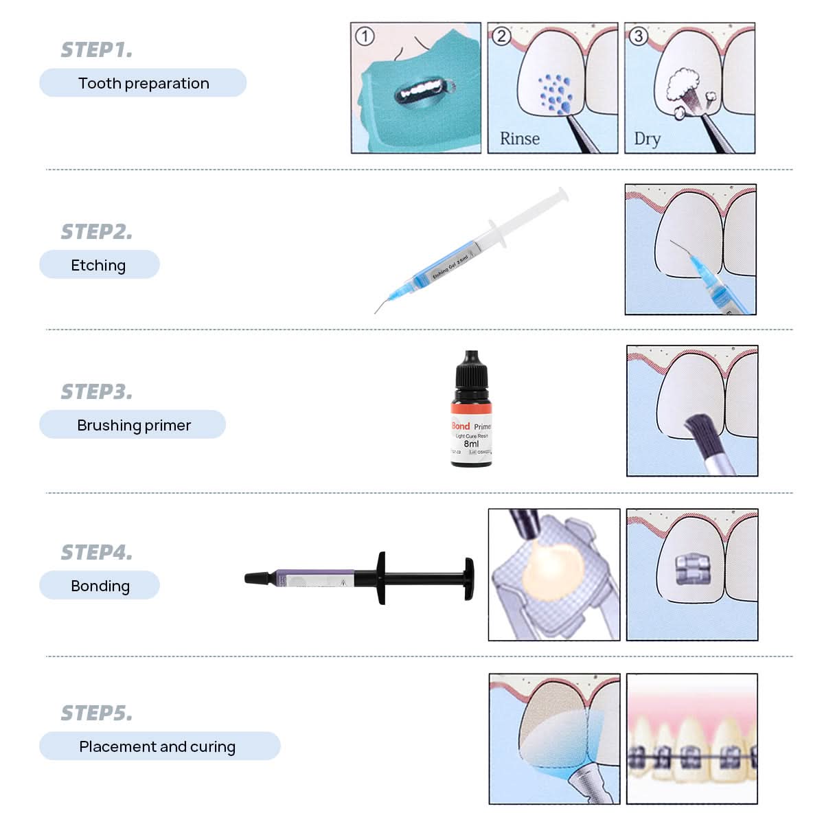 Light Cure Orthodontic Adhesive Kit Bonding Bracket Syringes 3pcs 10.5g - pairaydental.com
