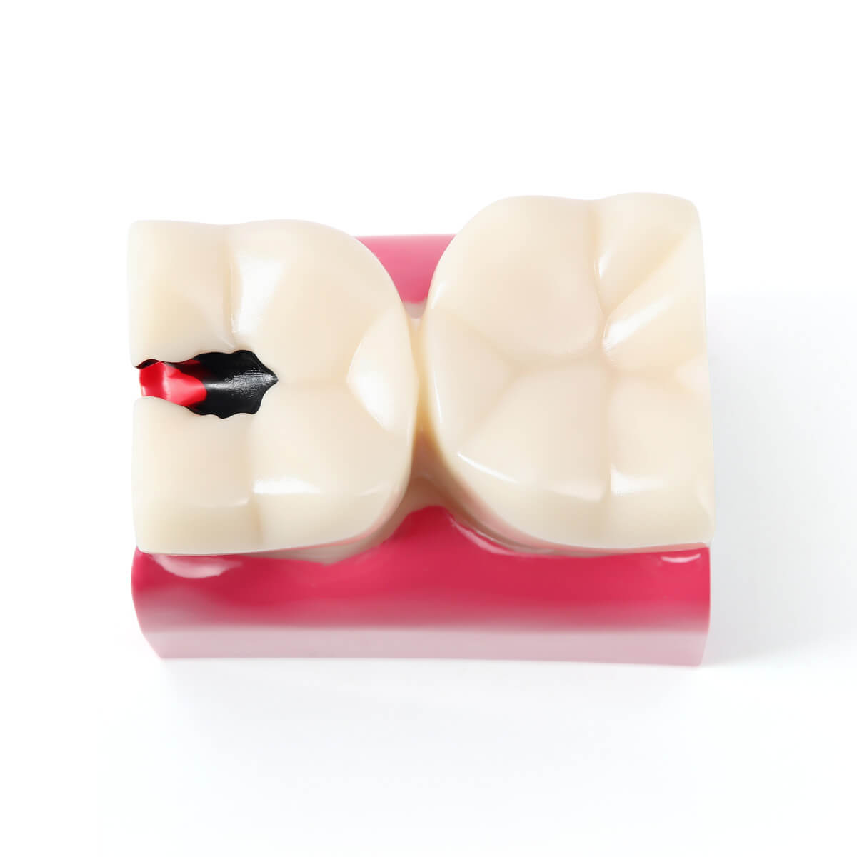 6 Times Dental Caries Anatomy Comparison Model Teaching Learning Tools - pairaydental.com