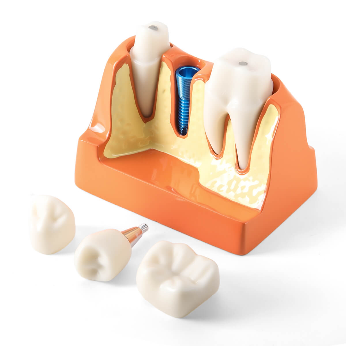 Dental 4 Times Teeth Model Implant Analysis Crown Bridge Demonstration Removable Model - pairaydental.com