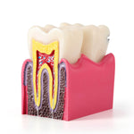 6 Times Dental Caries Anatomy Comparison Model Teaching Learning Tools - pairaydental.com