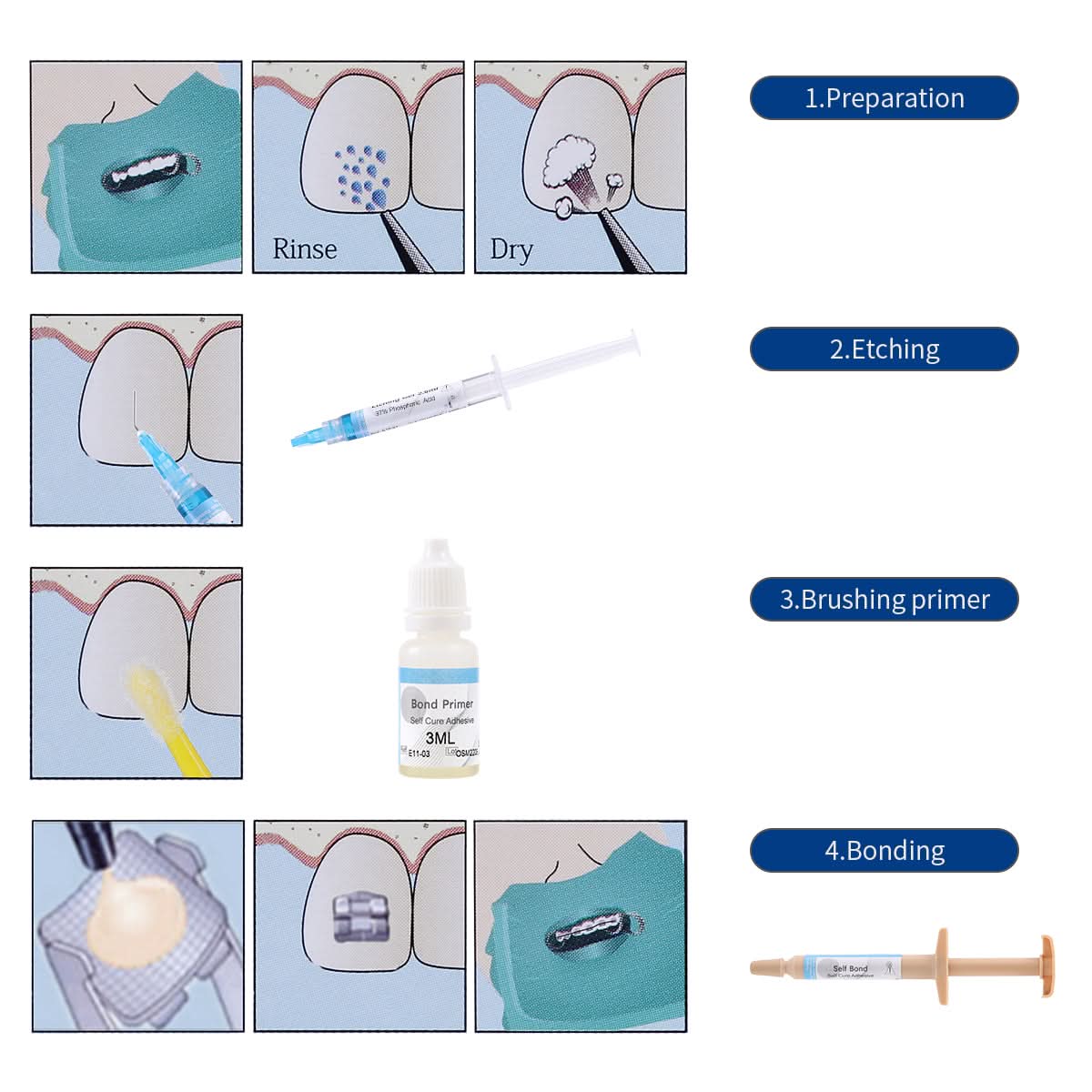 Orthodontic Adhesive No-Mix Direct Bonding Kit 3.5g - AZDENT Orthodontic Adhesive No-Mix Direct Bonding Kit 3.5g - AZDENT