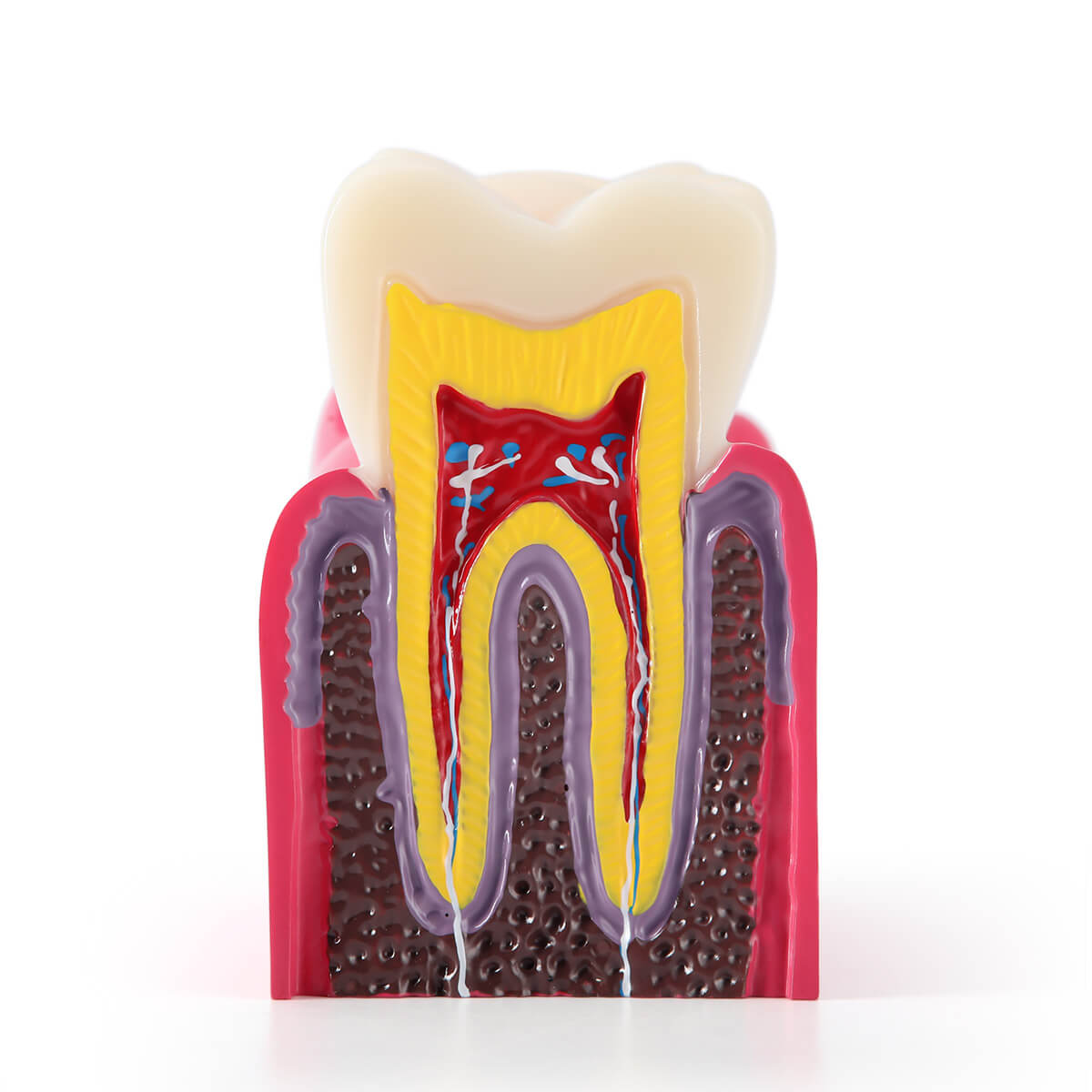 6 Times Dental Caries Anatomy Comparison Model Teaching Learning Tools - pairaydental.com