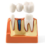 Dental 4 Times Teeth Model Implant Analysis Crown Bridge Demonstration Removable Model - pairaydental.com