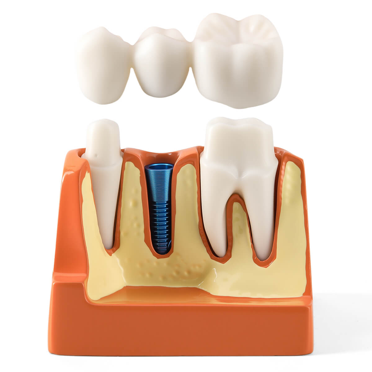 Dental 4 Times Teeth Model Implant Analysis Crown Bridge Demonstration Removable Model - pairaydental.com
