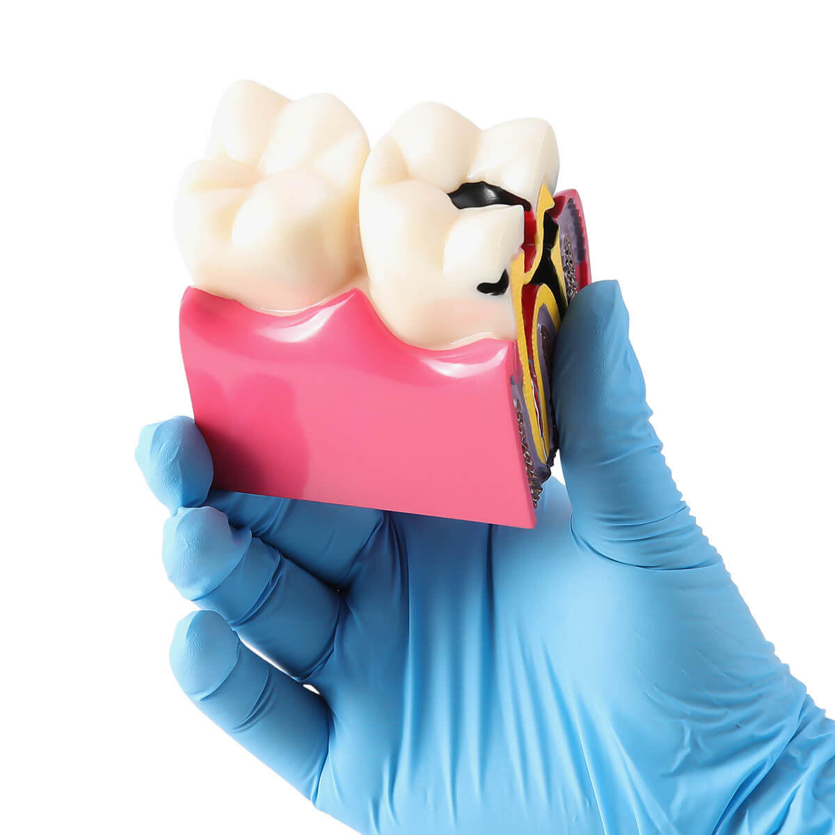 6 Times Dental Caries Anatomy Comparison Model Teaching Learning Tools - pairaydental.com