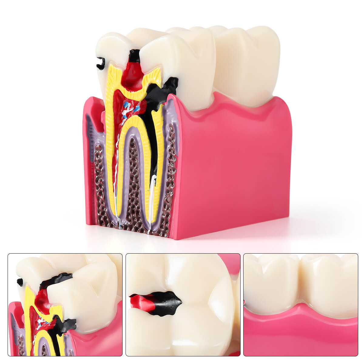 6 Times Dental Caries Anatomy Comparison Model Teaching Learning Tools - pairaydental.com
