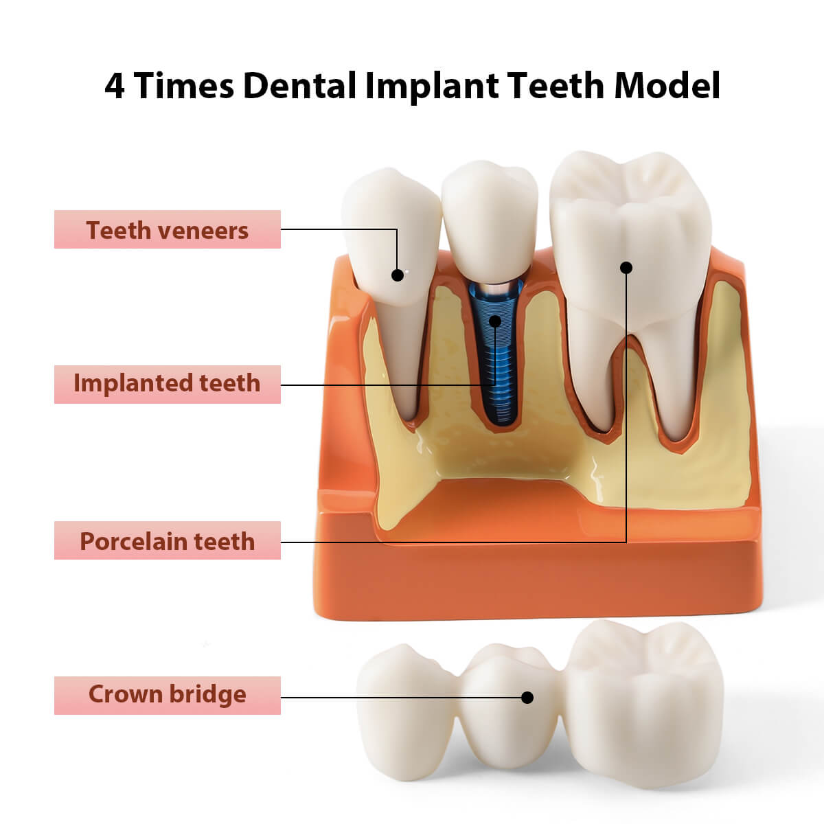 Dental 4 Times Teeth Model Implant Analysis Crown Bridge Demonstration Removable Model - pairaydental.com