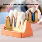 Dental 4 Times Teeth Model Implant Analysis Crown Bridge Demonstration Removable Model - pairaydental.com