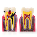 6 Times Dental Caries Anatomy Comparison Model Teaching Learning Tools - pairaydental.com