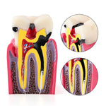 6 Times Dental Caries Anatomy Comparison Model Teaching Learning Tools - pairaydental.com