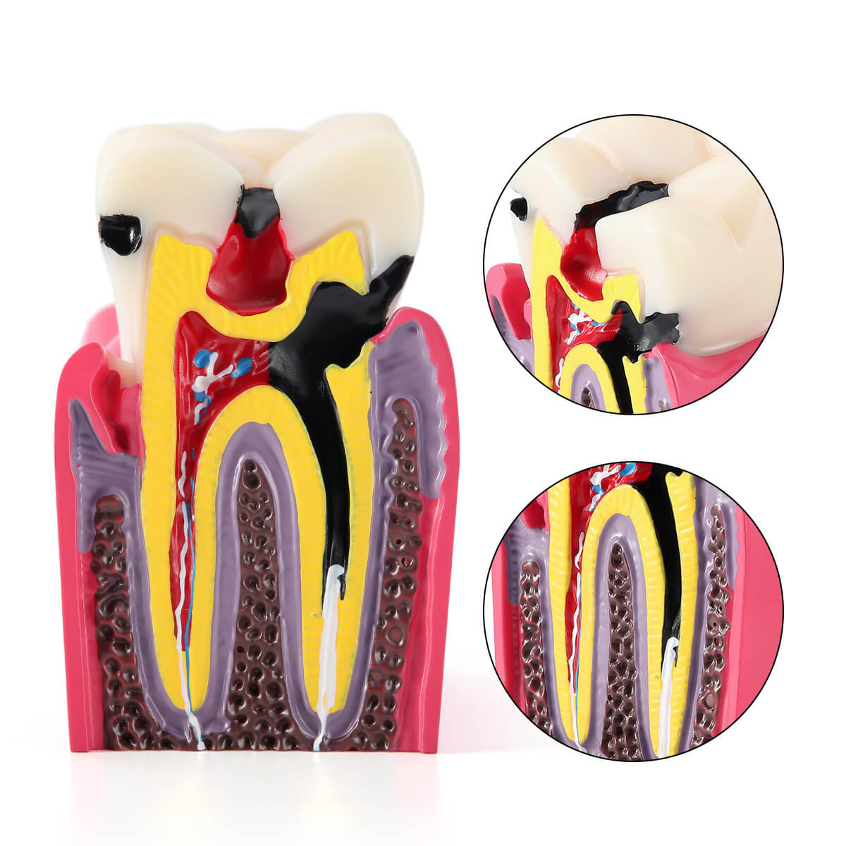 6 Times Dental Caries Anatomy Comparison Model Teaching Learning Tools - pairaydental.com