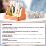 Dental 4 Times Teeth Model Implant Analysis Crown Bridge Demonstration Removable Model - pairaydental.com