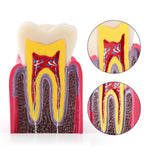 6 Times Dental Caries Anatomy Comparison Model Teaching Learning Tools - pairaydental.com
