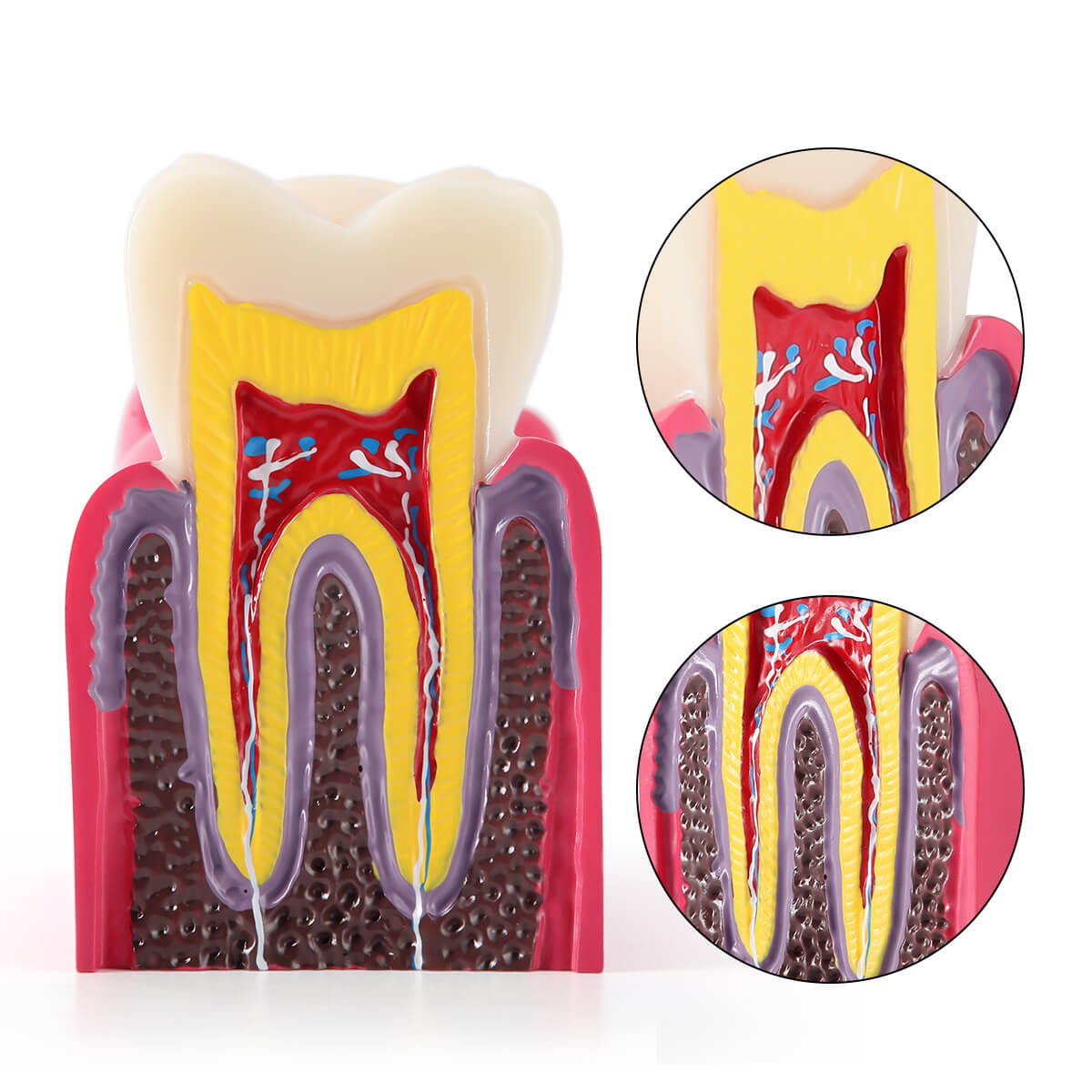 6 Times Dental Caries Anatomy Comparison Model Teaching Learning Tools - pairaydental.com