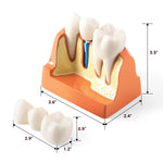 Dental 4 Times Teeth Model Implant Analysis Crown Bridge Demonstration Removable Model - pairaydental.com
