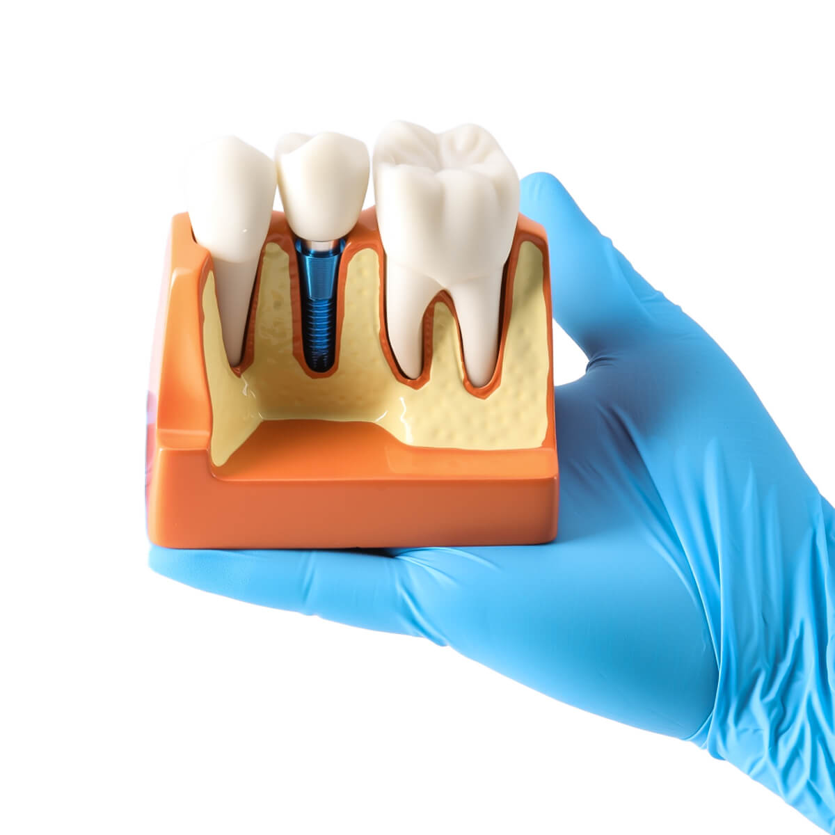 Dental 4 Times Teeth Model Implant Analysis Crown Bridge Demonstration Removable Model - pairaydental.com