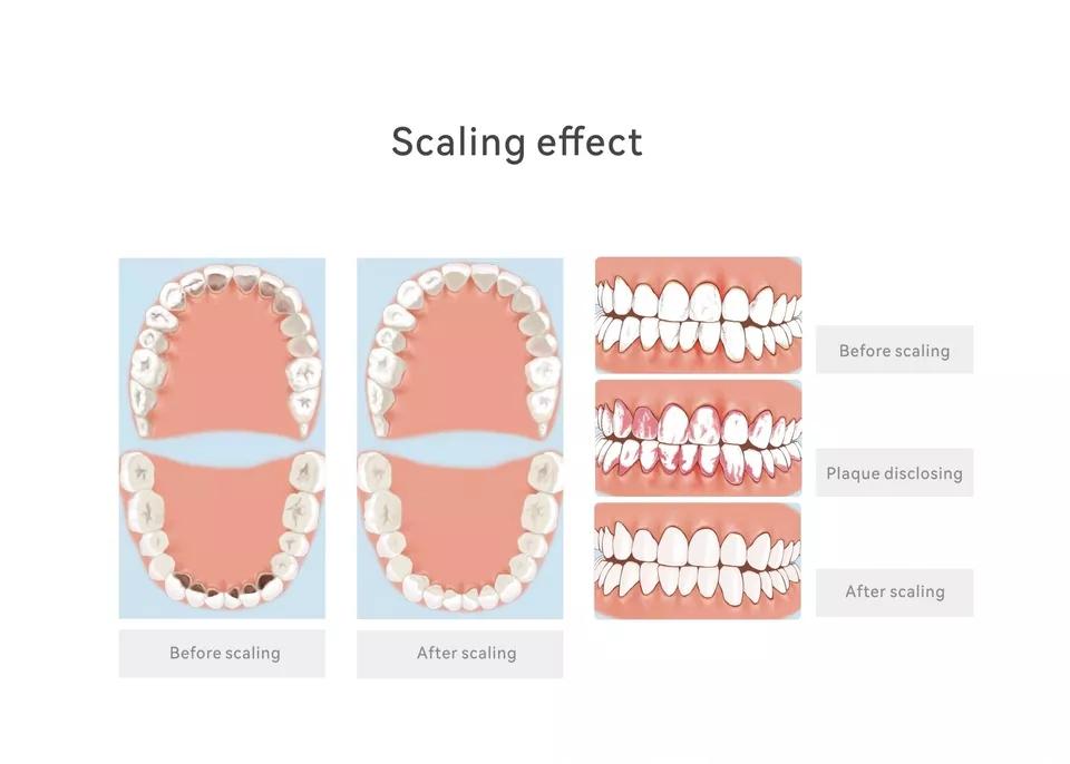 Woodpecker PT-A Dental Ultrasonic Scaler & Air Polisher System - pairaydental.com