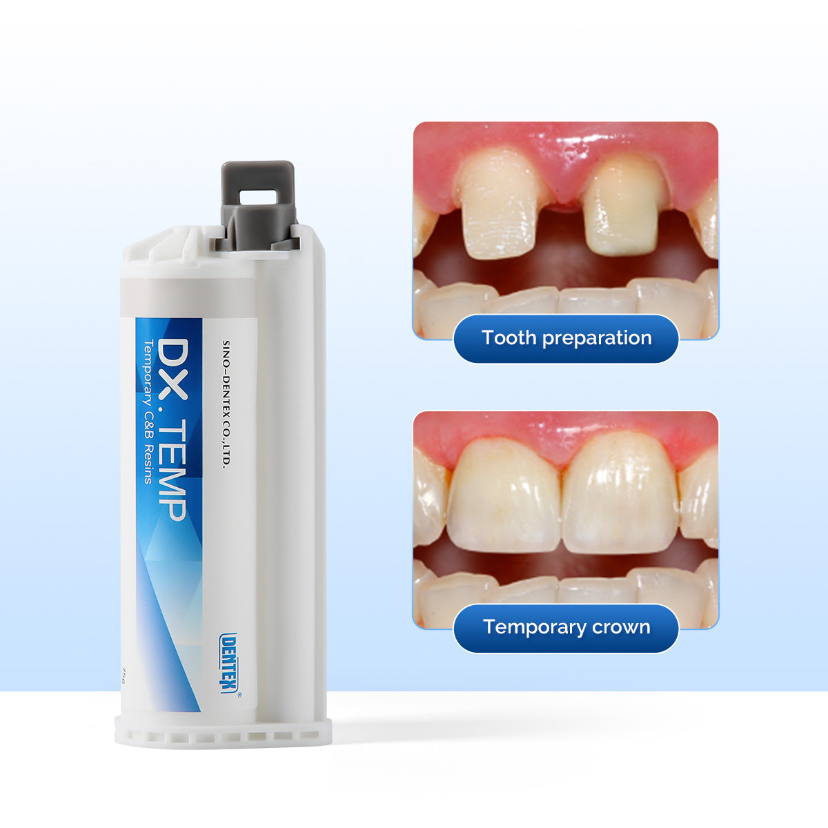 DENTEX Dental Self Cure Temporary C&B Resin A1/A2/A3 with 10pcs Mix Tips - pairaydental.com 