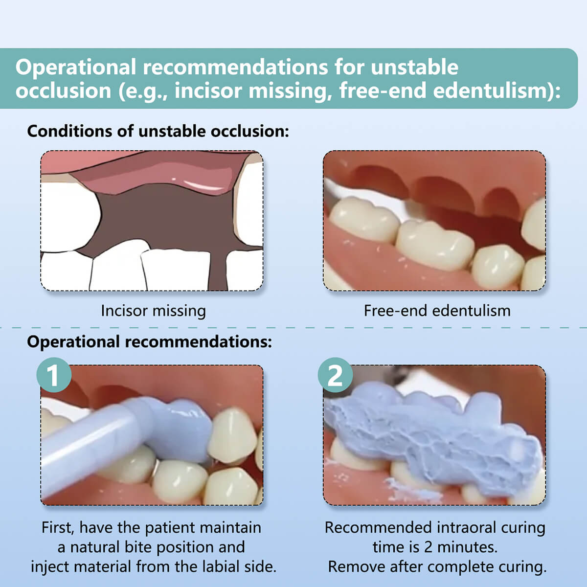 Dental Bite Registration Material Fast Set Mixing Tips 50ML*2 - pairaydental.com