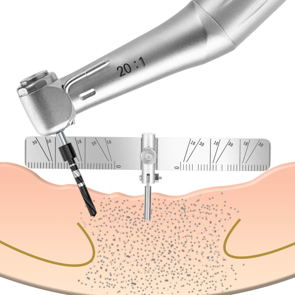 Implant Guide Key Dental Implant Locating Guide Rule – pairaydental