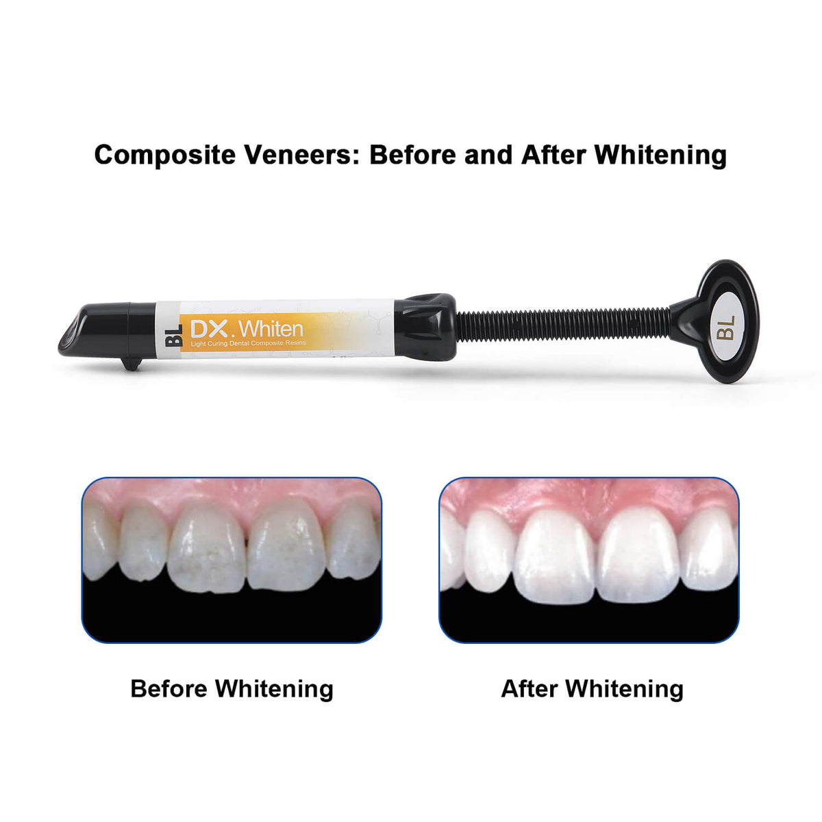 Dental Veneer Composite Resin Light Cure Bonding Adhesive for Teeth Whitening EXW/BL/EW 4g/Pack - pairaydental.com