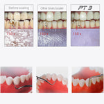Woodpecker PT3 Painless Periodontal Treatment Device Ultrasonic Scaler Automatic Water Supply System with Titanium Tips - pairaydental.com