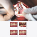 Woodpecker PT3 Painless Periodontal Treatment Device Ultrasonic Scaler Automatic Water Supply System with Titanium Tips - pairaydental.com