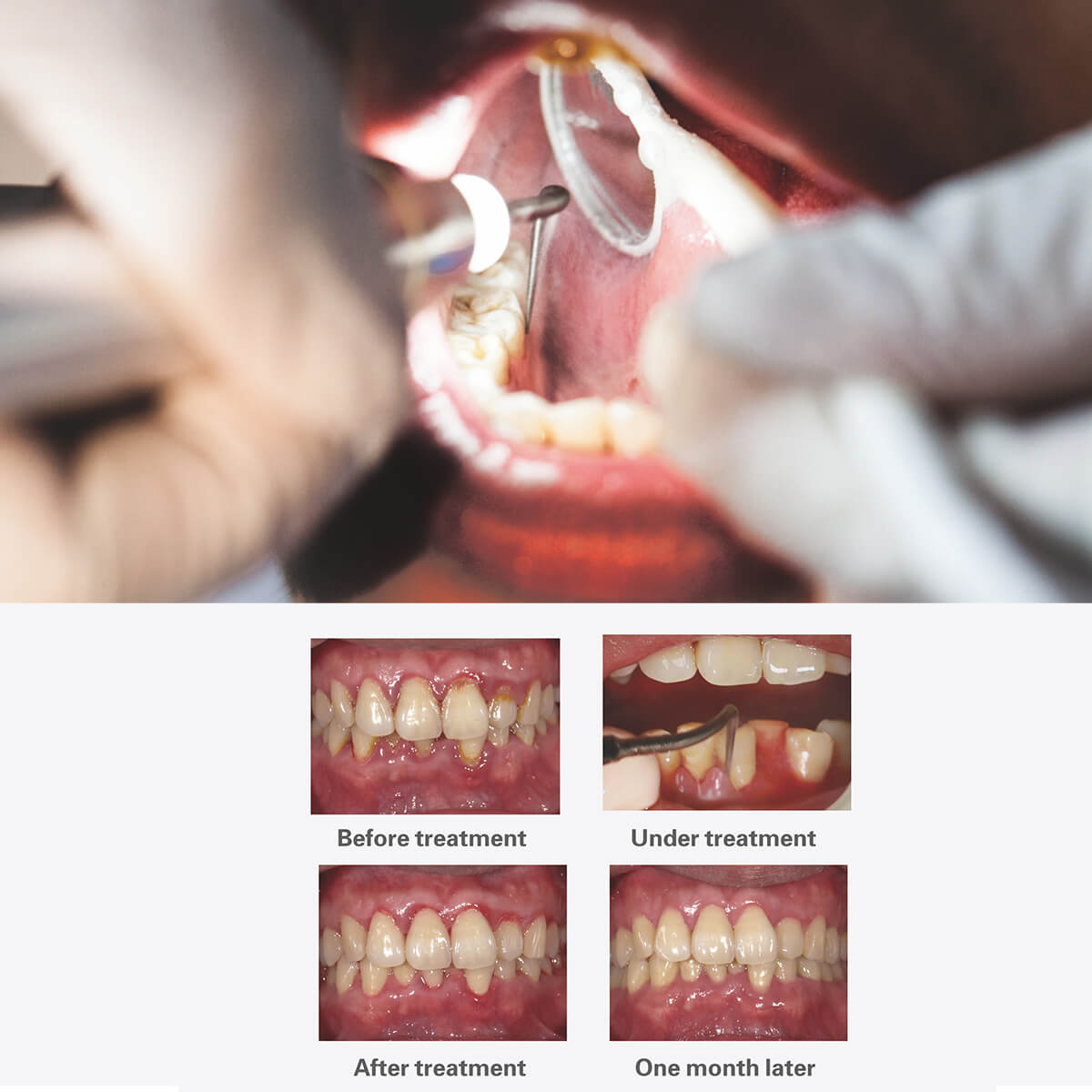 Woodpecker PT5 Painless Periodontal Treatment Device Ultrasonic Scaler Automatic Water Supply System with Titanium Tips - pairaydental.com
