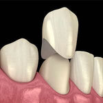 Dental Temporary Crown Kit Mixed 22#23#24# 72pcs/Box - pairaydental.com