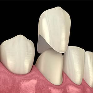 Dental Temporary Crown Kit Mixed 22#23#24# 72pcs/Box - pairaydental.com