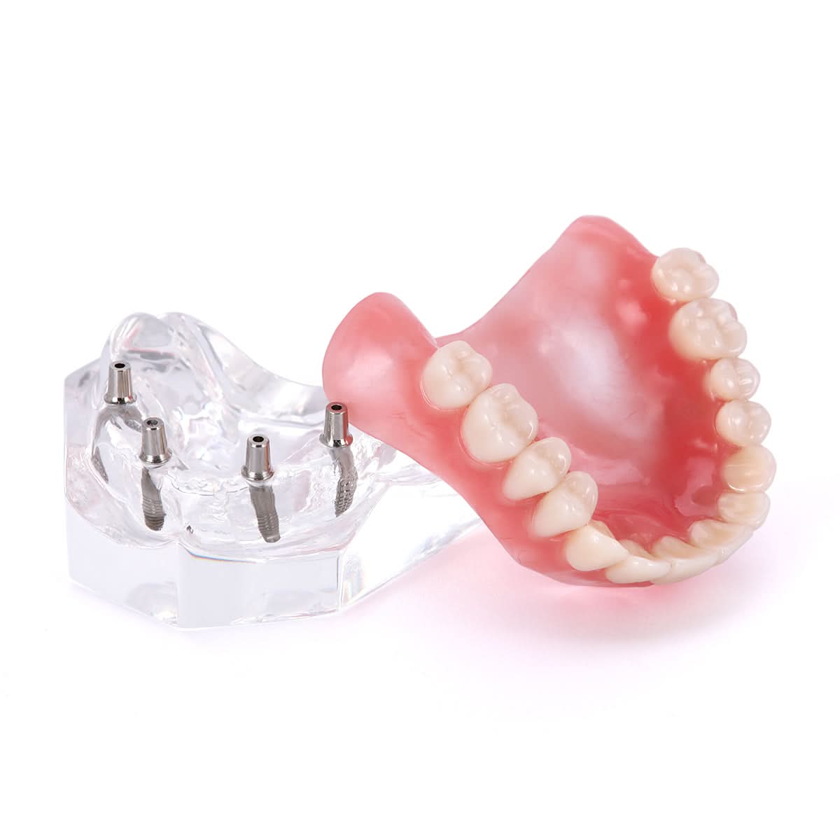 Dental Implant Teeth Model Demonstration Overdenture Restoration 4 Upper Implants M6001X - pairaydental.com