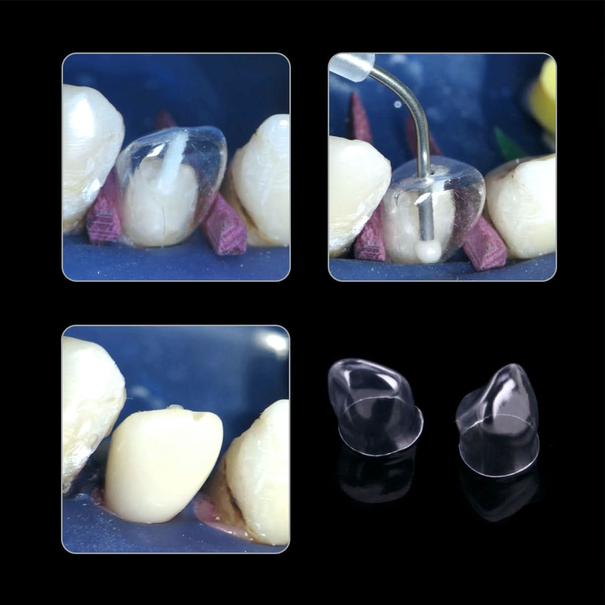 Dental Anterior Transparent Crowns № 1.910 64Pcs/Box - pairaydental.com