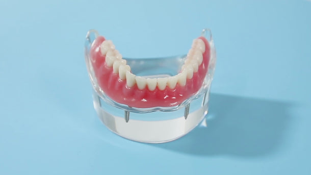 Dental Implant Teeth Model Demonstration Overdenture Restoration 4 Lower Implants M6003 - pairaydental.com