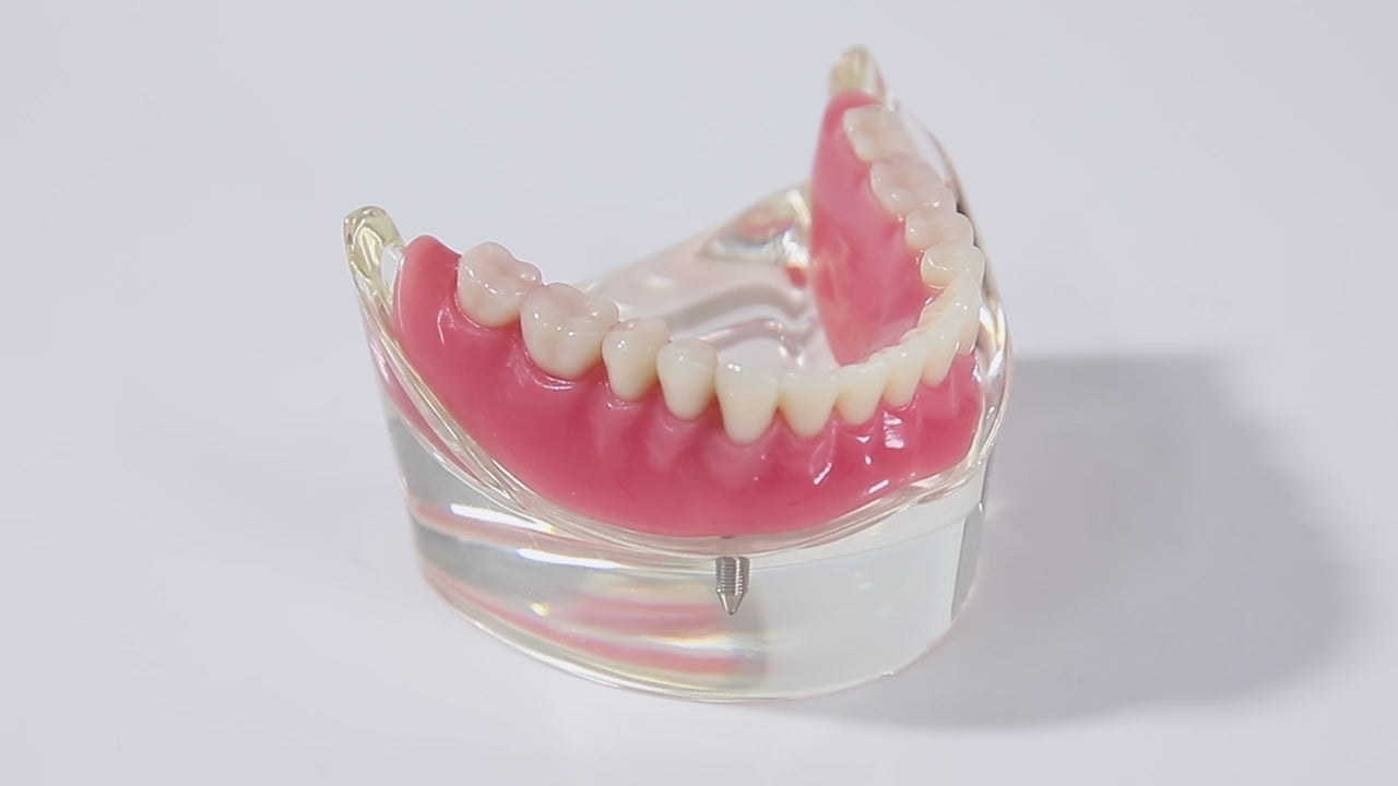 Dental Implant Teeth Model Demonstration Overdenture Restoration 2 Lower Implants M6002 - pairaydental.com