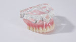 Dental Implant Teeth Model Demonstration Overdenture Restoration 4 Upper Implants M6001X - pairaydental.com