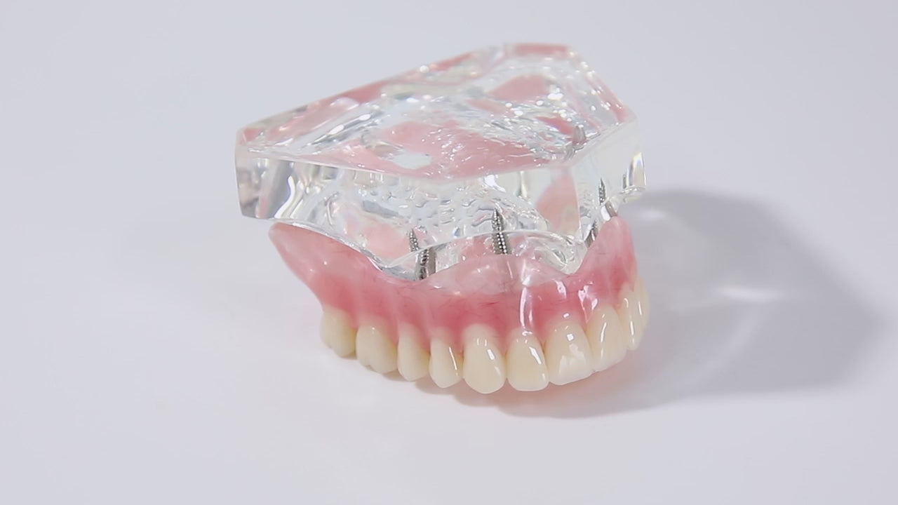 Dental Implant Teeth Model Demonstration Overdenture Restoration 4 Upper Implants M6001X - pairaydental.com