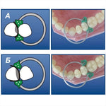 Dental Add On Wedges Silicone Rubber 40Pcs/Bag - pairaydental.com