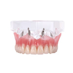 Dental Implant Teeth Model Demonstration Overdenture Restoration 4 Upper Implants M6001X - pairaydental.com