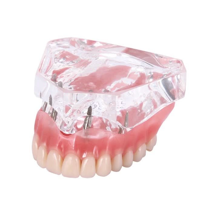 Dental Implant Teeth Model Demonstration Overdenture Restoration 4 Upper Implants M6001X - pairaydental.com