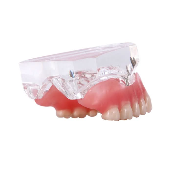 Dental Implant Teeth Model Demonstration Overdenture Restoration 4 Upper Implants M6001X - pairaydental.com