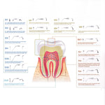 ED3 Ultrasonic Scaler Endodontic Tips - pairaydental.com