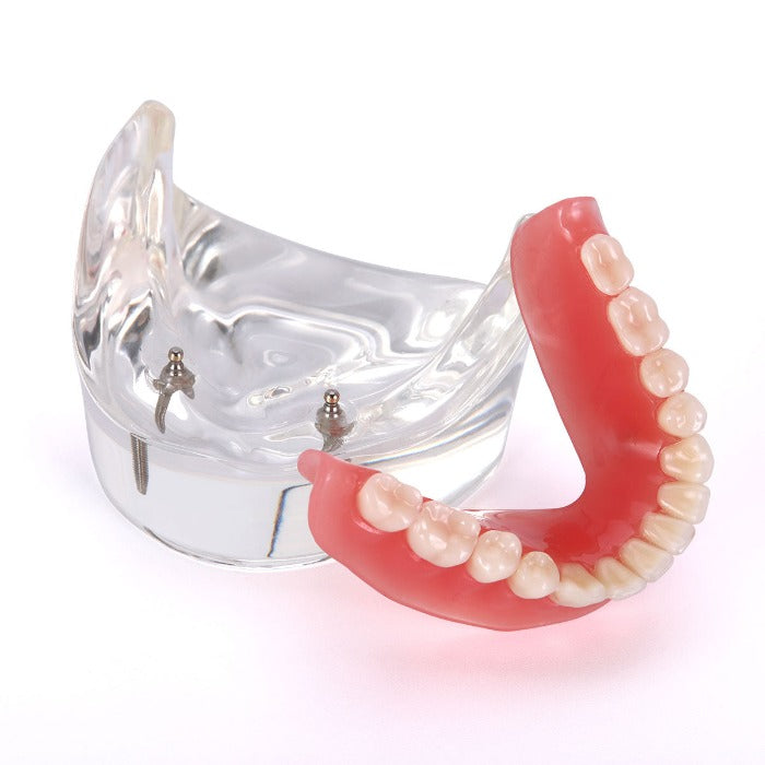 Dental Implant Teeth Model Demonstration Overdenture Restoration 2 Lower Implants M6002 - pairaydental.com