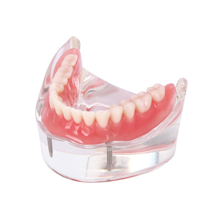 Dental Implant Teeth Model Demonstration Overdenture Restoration 2 Lower Implants M6002 - pairaydental.com 