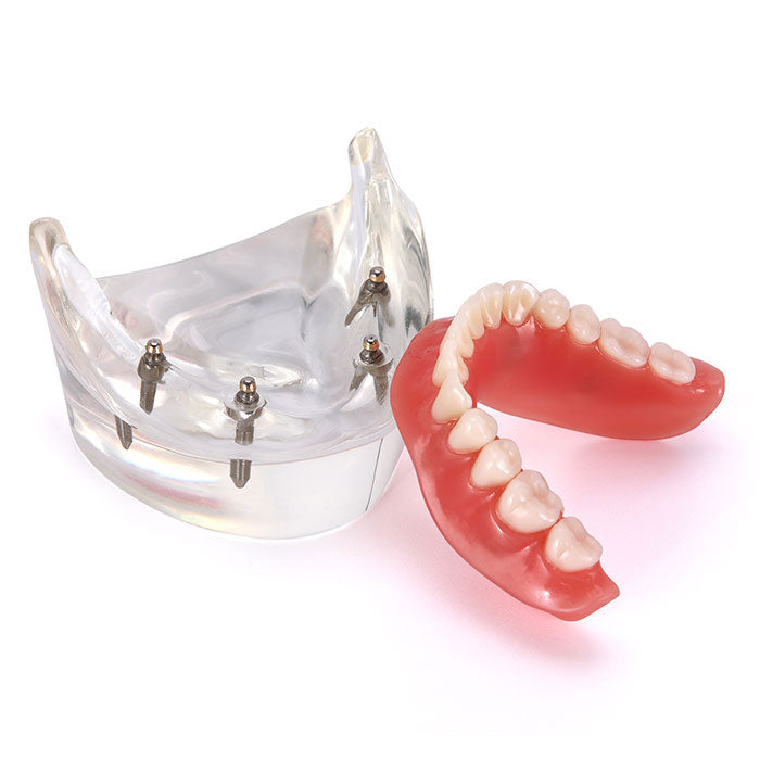 Dental Implant Teeth Model Demonstration Overdenture Restoration 4 Lower Implants M6003 - pairaydental.com
