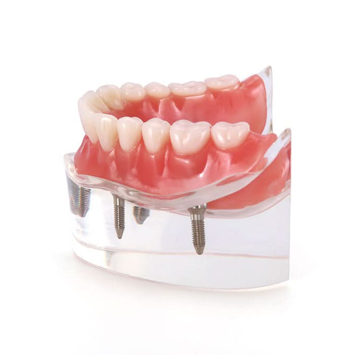 Dental Implant Teeth Model Demonstration Overdenture Restoration 4 Lower Implants M6003 - pairaydental.com