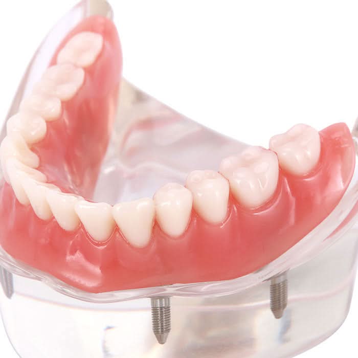 Dental Implant Teeth Model Demonstration Overdenture Restoration 4 Lower Implants M6003 - pairaydental.com